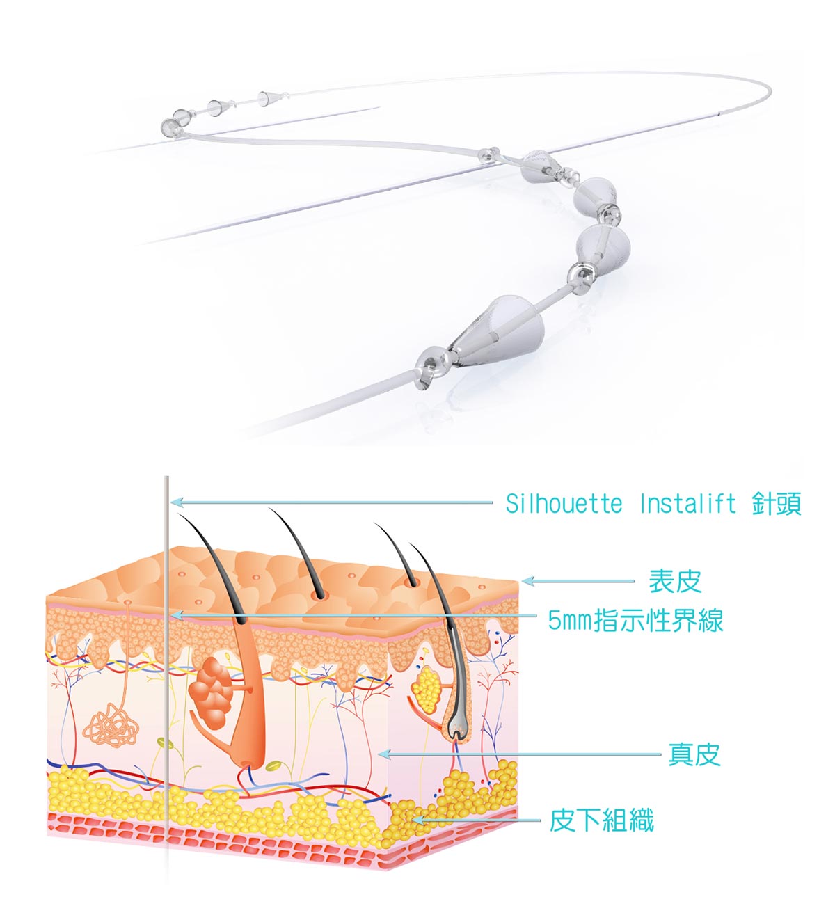 Silhouette Instalift - 療程原理